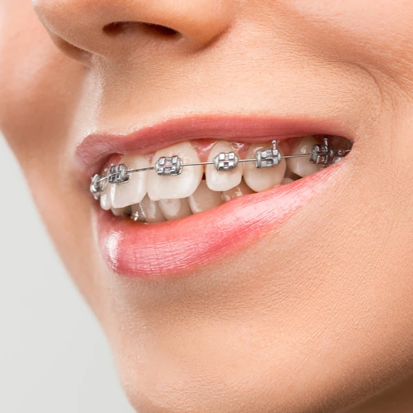 Put do savršenog osmijeha